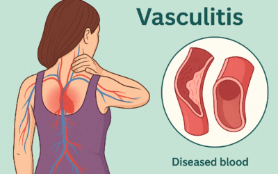 Vasculitis: una enfermedad poco conocida que puede afectar todo el cuerpo