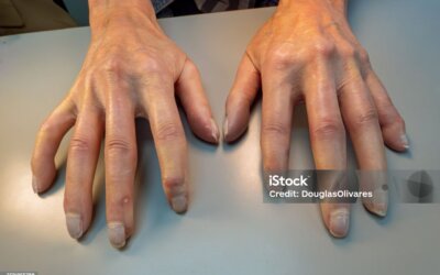 Esclerodermia: síntomas, causas, diagnóstico.