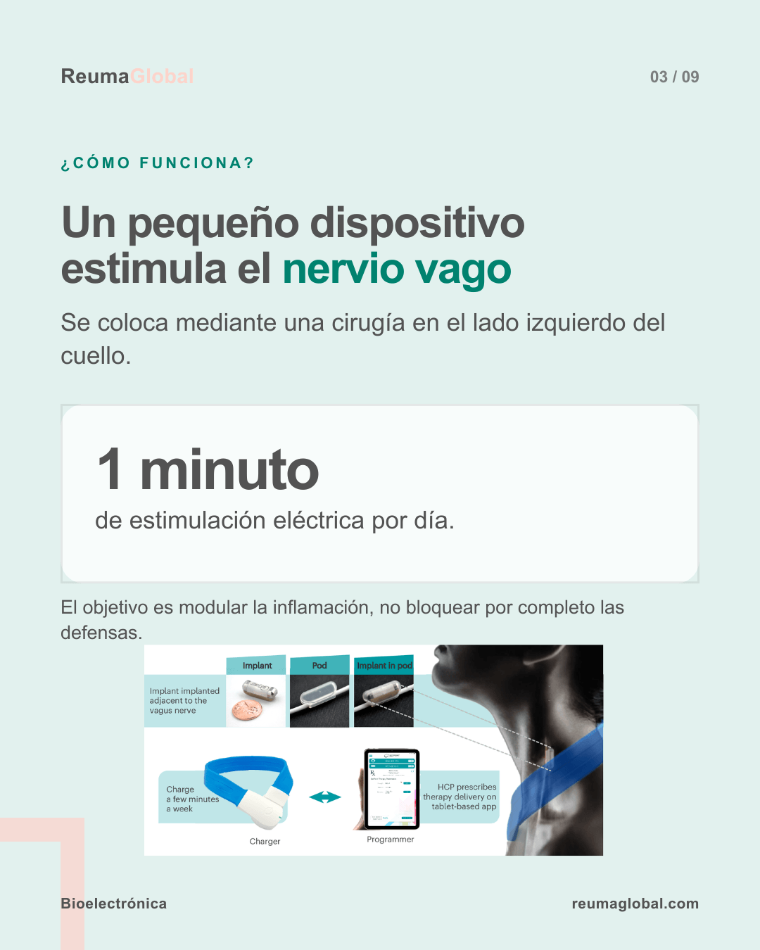 Cómo funciona la estimulación implantable del nervio vago